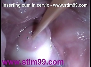 Insertion semen cum encircling cervix with regard to distension bawdy cleft speculum